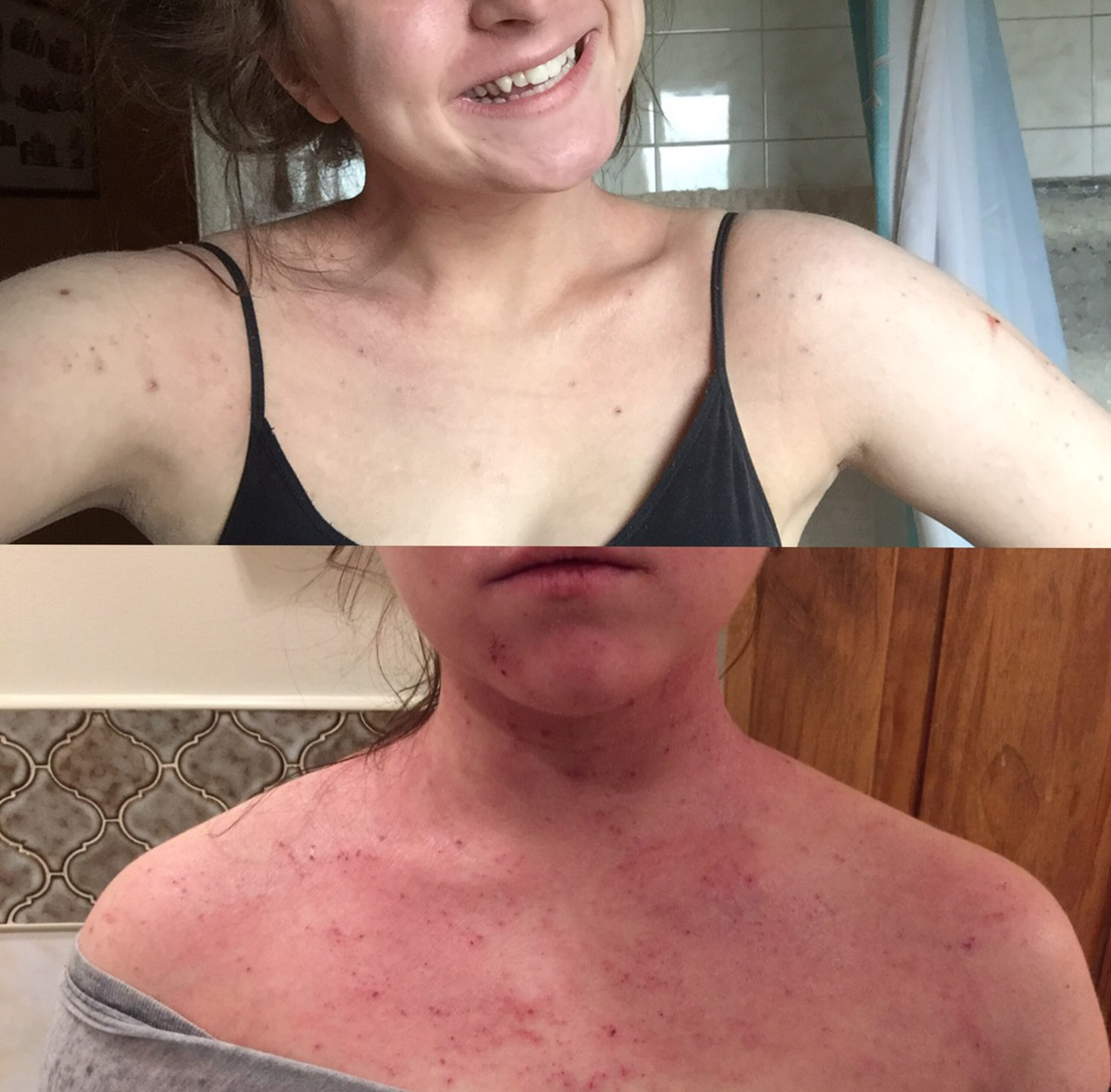 Woman, 22, credits bizarre Aussie product for curing her crippling eczema