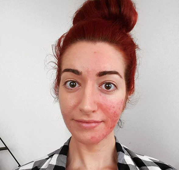 Woman with severe acne reveals how she hides her spots