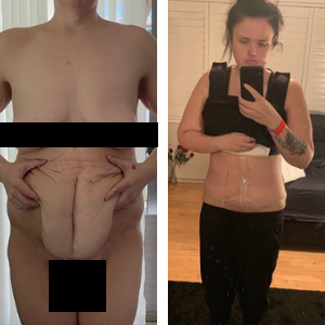 Australian woman removes excess skin after 84kg weightloss